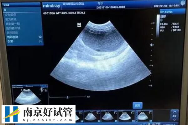 取卵后的第三天还是第七天是腹水高峰期呢？(图1)