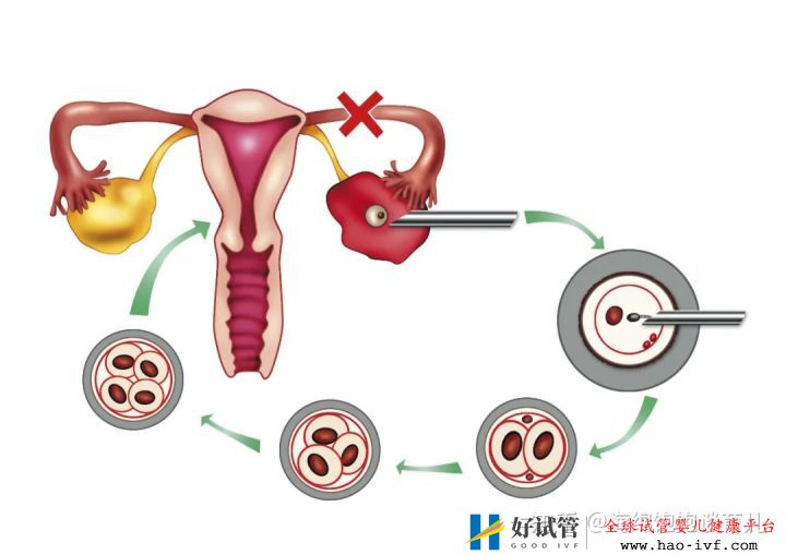 试管婴儿1代、2代、3代、4代哪个最好真实操作过...(图8) 试管婴儿1代、2代、3代、4代哪个最好真实操作过...(图8)